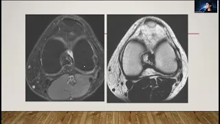 ISMRM MR Academy: How to Read Knee MRI: Intro and ACL/PCL