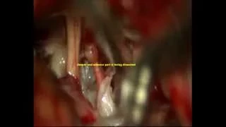 TRIGEMINAL NEURALGIA-EPIDERMOID-C-P ANGLE-microsurgery-dr suresh dugani /HUBLI/KARNATAK/INDIA