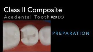 Class II Composite Preparation - Acadental Tooth #20 DO