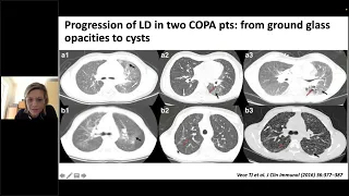 How I diagnose interstitial lung disease in different immune-mediated disorders? | Dr Bracaglia