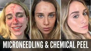 MICRONEEDLING & CHEMICAL PEEL EXPERIENCE | AFTER CARE | BEFORE & AFTER | FOREVER YOUNG? | KOKOBEAUTE