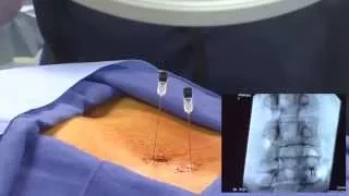 WATCH an Epidural Steroid Injection Demonstration - LIVE!