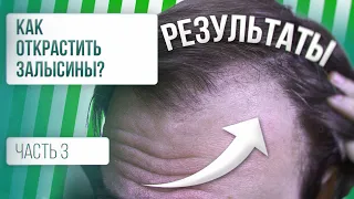 Как остановить выпадение волос? / РЕЗУЛЬТАТЫ [Часть 3]