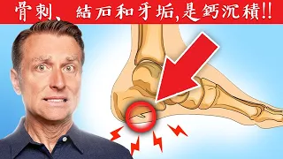 長骨刺,結石和牙結石,鈣沉積8原因,自然療法,柏格醫生 Dr Berg