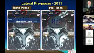 Neel Anand, MD - "Can a Comprehensive Staged Protocol for Circumferential Minimal Invasive..."