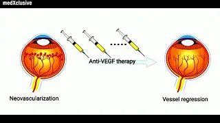 FDA Approves Ranibizumab Ocular Implant for Age-Related Macular Degeneration [AMD]