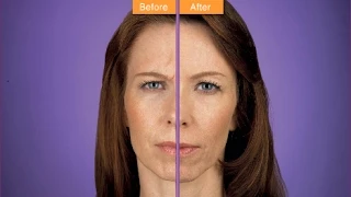 Botoks Uygulamaları - Botox ve dolgu işlemleri nasıl yapılır?