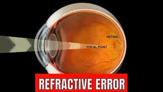Refractive error Of eye
