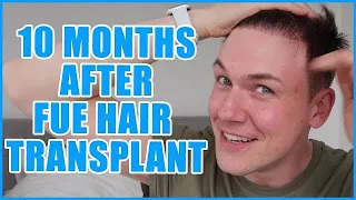 FUE Hair Transplant | Month 10 | Before & After, New Hairline | No Scarring | Progress Update