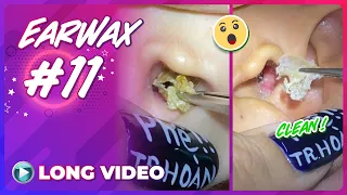 EP 11 Earwax ASMR | Series remove earwax after not cleaning for a long time