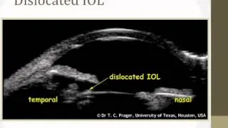 New technologies in Glaucoma: UBM