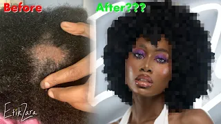 I WAS GOING BALD via SCALP FUNGUS (4C/B/A NATURAL HAIR) + GROW back MY JOURNEY #ScalpCare | EfikZara