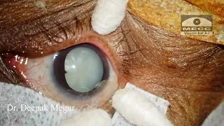 Technique of Surgical Draping for Ocular Surgery- Dr Deepak Megur