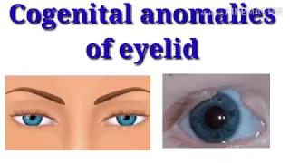 Congenital lid anomalies || ptosis || lid coloboma || Epicanthus || Distichiasis || cryptophthalmos