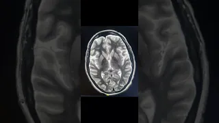 Creutzfeldt-Jakob Disease #mri #cjd