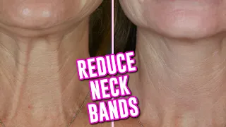 HOW TO REDUCE NECK BANDS AT HOME WITHOUT SURGERY | 4 EASY TIPS!