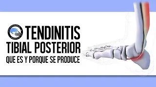 Tendinitis del tibial posterior, que es y por que se produce