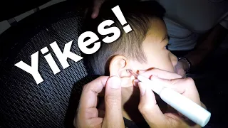 Huge Dry Earwax Removed From Boy's Ear