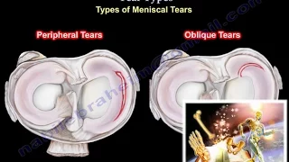 knee pain, Meniscus Tear ,types- Everything You Need To Know - Dr. Nabil Ebraheim