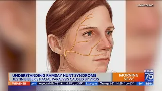 What is Ramsay Hunt syndrome?