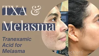 Tranexamic Acid for Melasma: Skip Creams & Pills - Try This Instead #TranexamicAcidforMelasma