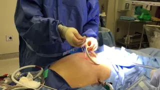 Easy way to remove Alexis Wound Protector/Retractor