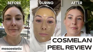 COSMELAN DEPIGMENTATION PEEL | chemical peel for pigmentation + dark spots