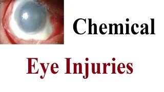 Chemical Eye Injuries (Acid & Alkaline eye Burn)