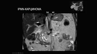 Рак поджелудочной железы Часть 2