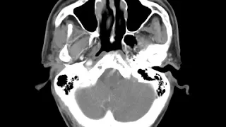 HN C8 Orbital Lymphoma (A)