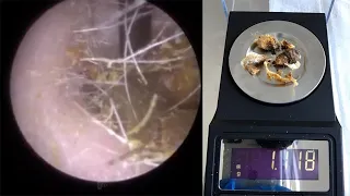 Consultant Audiologist Removes Heaviest Amount Of Ear Wax Ever