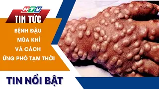 BỆNH ĐẬU MÙA KHỈ VÀ CÁCH ỨNG PHÓ TẠM THỜI | HTV Tin Tức