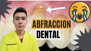 Desgaste en los cuellos de los dientes 🦷/ Abfraccion dental causa y tratamiento ✔