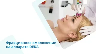 Лазерная шлифовка лица аппаратом SmartXide DOT от DEKA