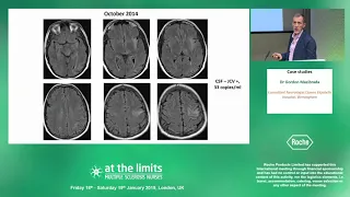 Dr Gordon Mazibrada - MS case studies