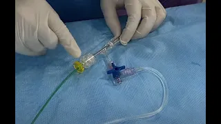 How to do Mechanical Thrombectomy? - Basic steps of Solumbra Technique