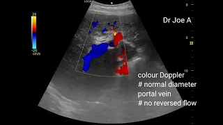 Coarse liver echotexture- early sign of cirrhosis- ultrasound video