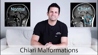 Chiari Malformations