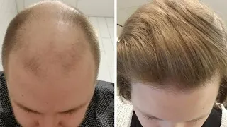Shocking Results of FINASTERIDE & MINOXIDIL after 1 YEAR !