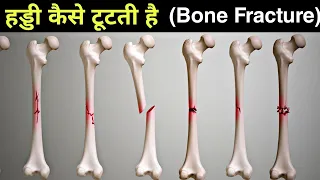 हड्डी कैसे टूट जाती हैं - types of bone fracture - 3D Animation