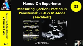 Measuring Ejection Fraction In Parasternal: -2-D & M-Mode (Teichholz)