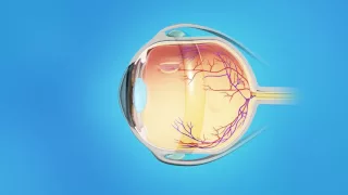 Detached Retina: Scleral Buckle