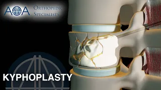 AOA Orthopedic Specialists - Kyphoplasty