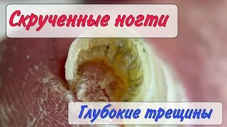 Скрученные ногти / кровавые трещины / трещины на ногах / как убрать трещины / болит палец