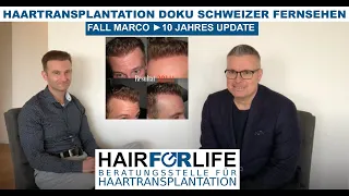 Haartransplantation Schweiz | Doku SRF Fernsehen | Marco`s Erfahrung  | 10 Jahres Update u. Beratung