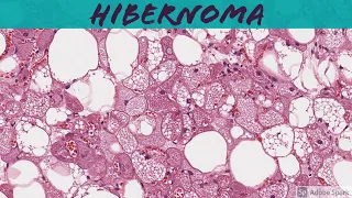 Hibernoma: 5-Minute Pathology Pearls