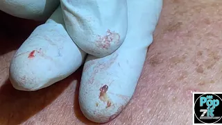 Back Blackhead extractions. Multiple dry clogged pores extracted on back. Big squeeze. MrPopZit.