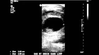 Pseudoaneurysm Evaluation: Post Angiogram - Case Study