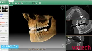 ¿Cómo se ven los Rayos X 3D Cone Beam? en Vatech A9 - Estudio 8.5 x 10 FOV - Orthosign