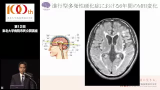 第12回市民公開講座　基調講演　多発性硬化症という病気をご存知ですか？